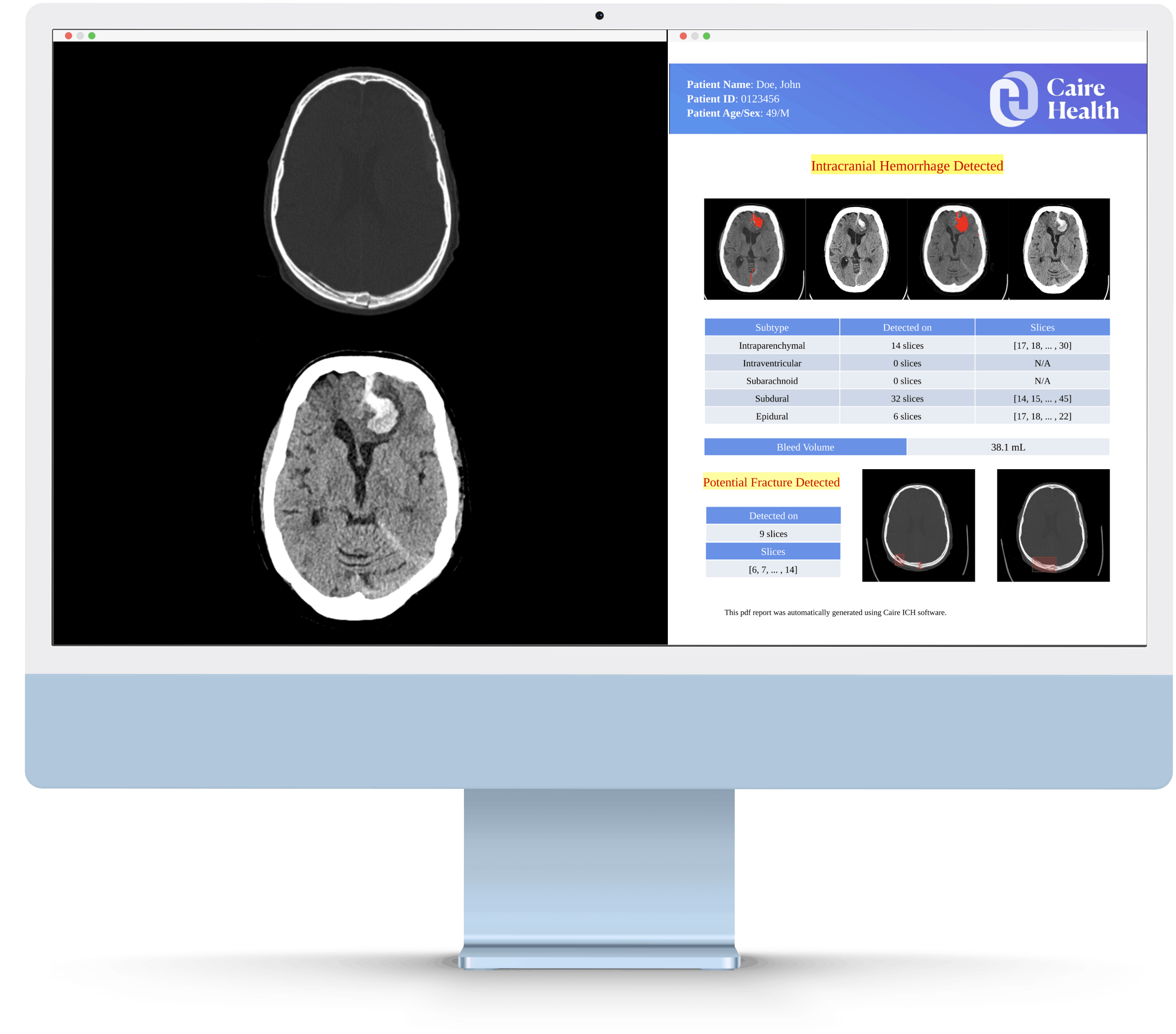 Caire Health workstation displaying a head CT alongside detected hemorrhage subtypes, bleed volume, and potential fracture findings